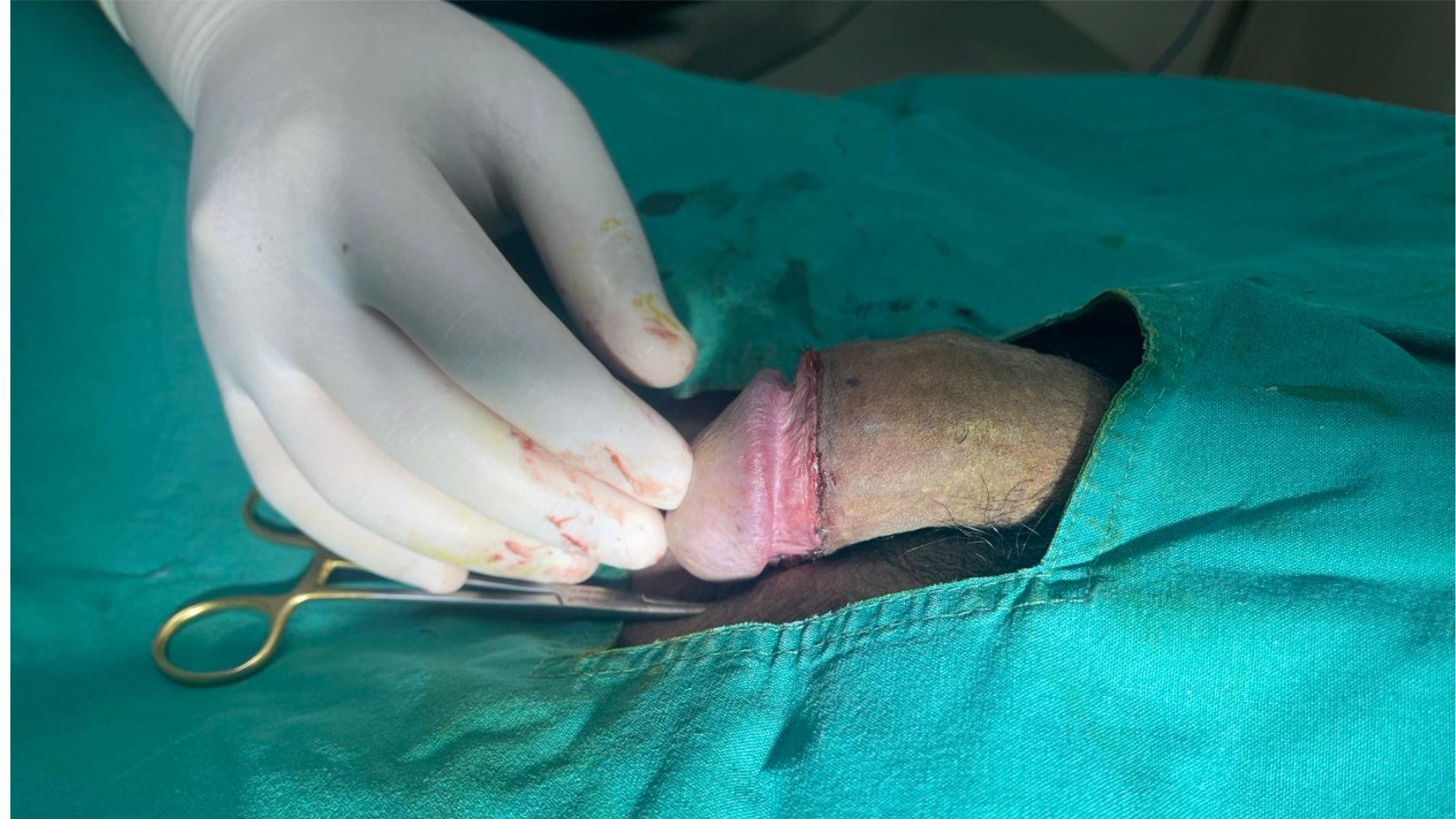 After Circumcision