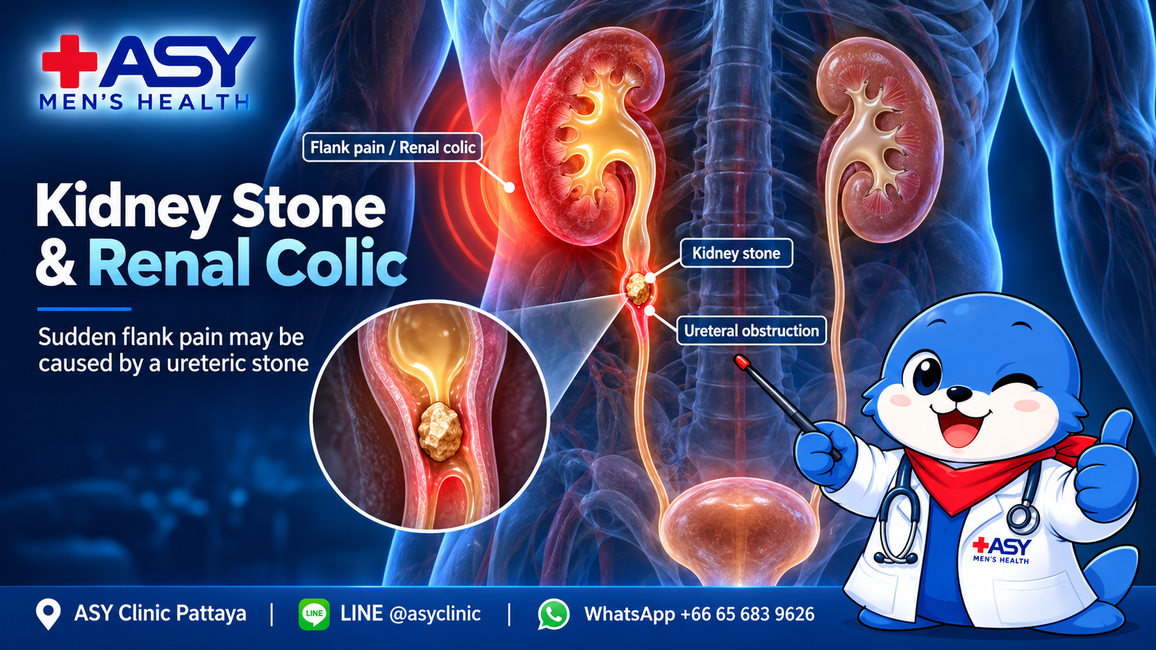 Anatomy diagram showing a ureteric stone causing urinary obstruction, hydronephrosis and kidney stone flank pain or renal colic