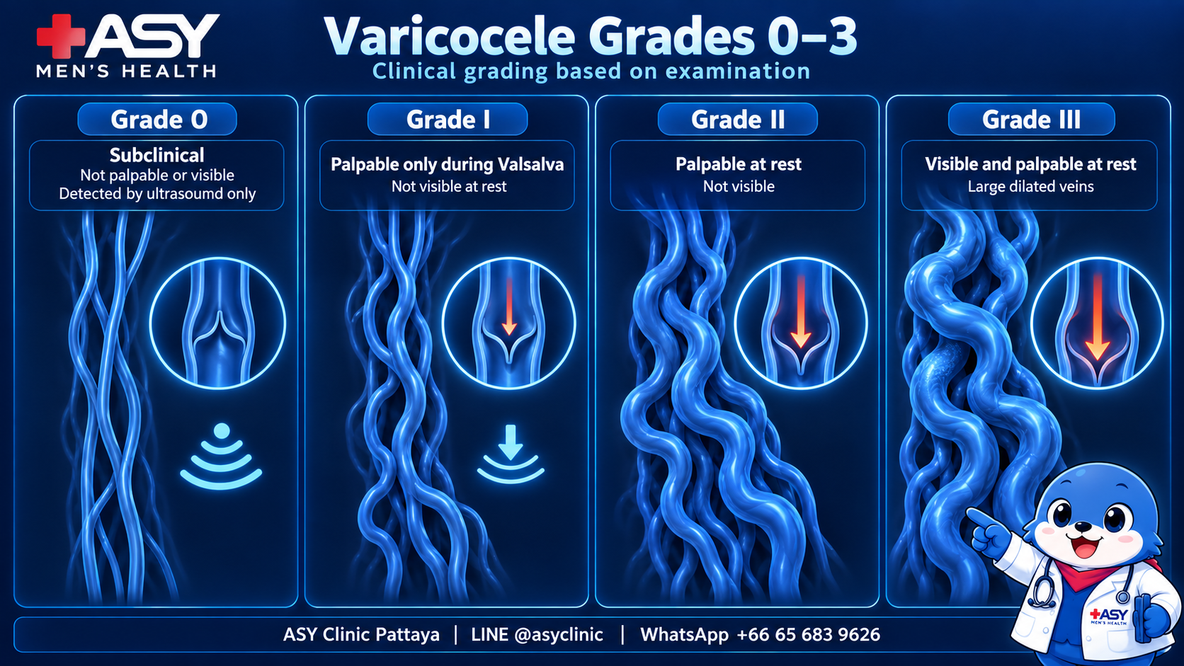 Varicocele Grades 0 to 3 diagram showing progressively dilated veins from subclinical varicocele to visible and palpable varicocele