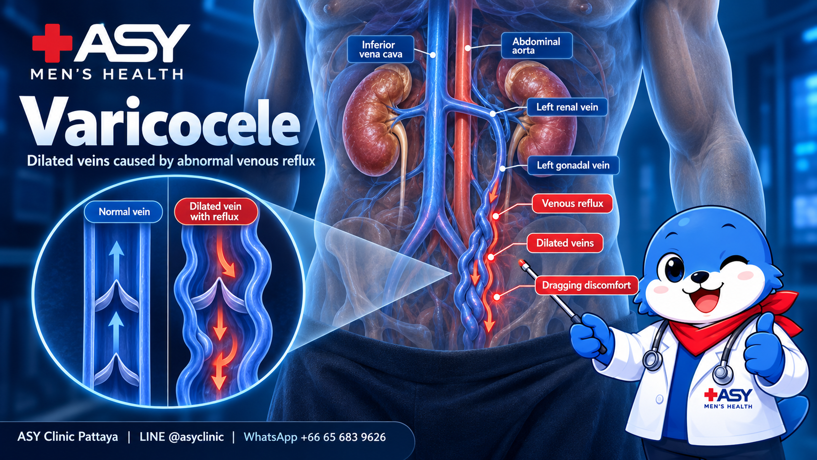 Anatomy diagram of varicocele showing abnormal blood reflux from the left renal vein into the left gonadal vein, causing dilated veins and dragging discomfort